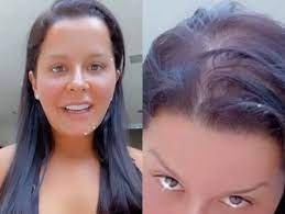 Queda de cabelo excessiva da Atriz Paloma Duarte tem tratamento