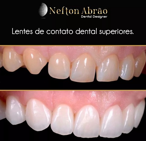 Nefton Abrão Dentista das Celebridades explica como ter um sorriso perfeito